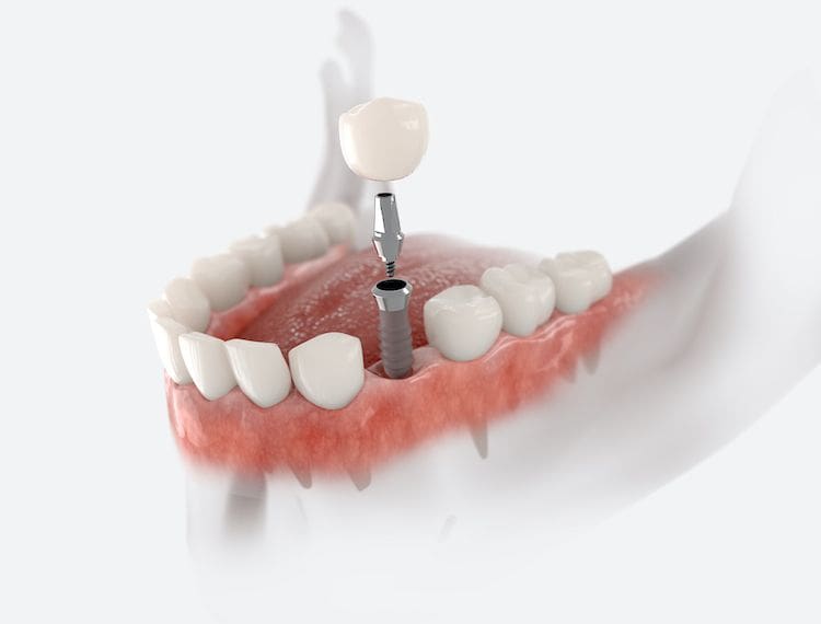 Dental Implants in Ravenwood, IN