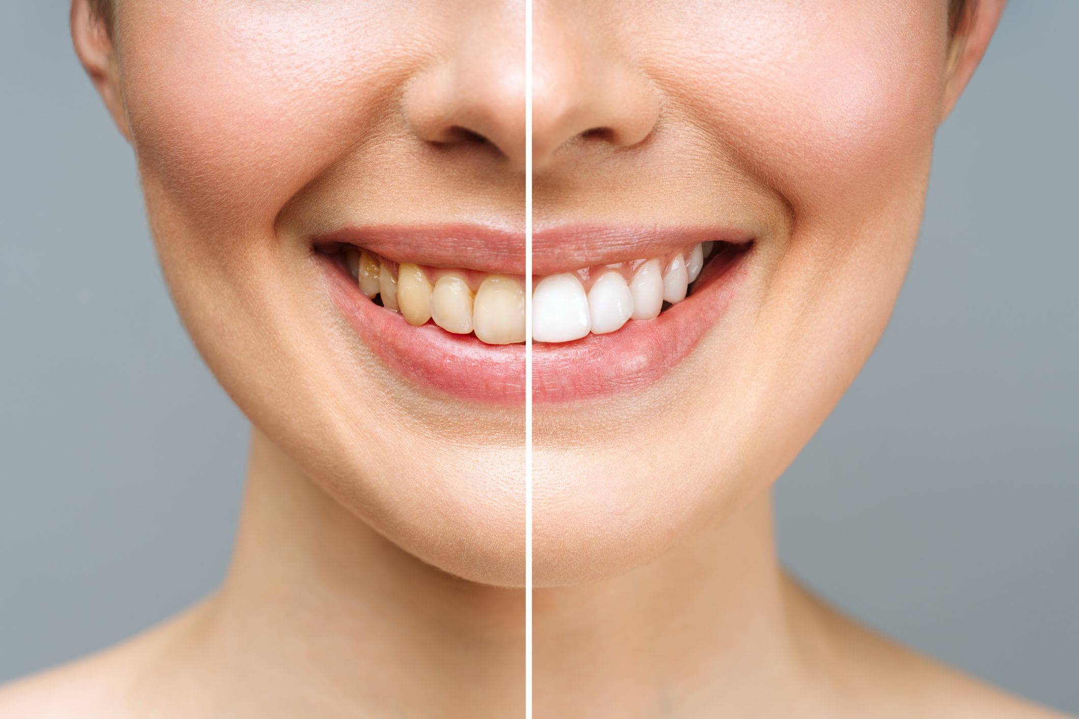 Teeth Whitening in St. John, IN