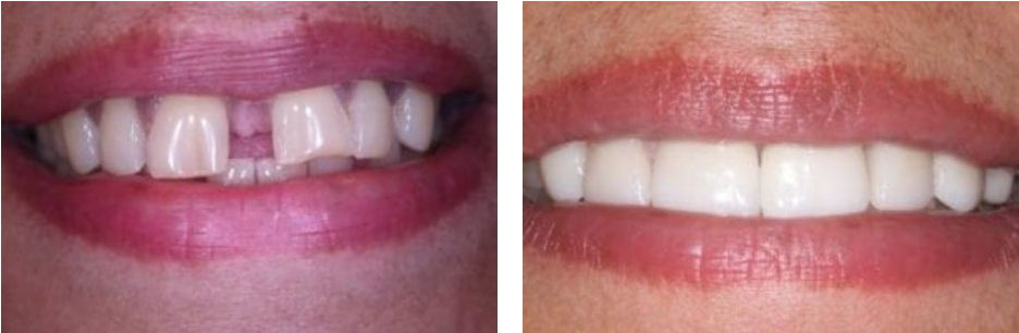 Before and after dental veneers