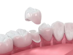 How Dental Crowns Can Sve Your Smile | St. John, IN